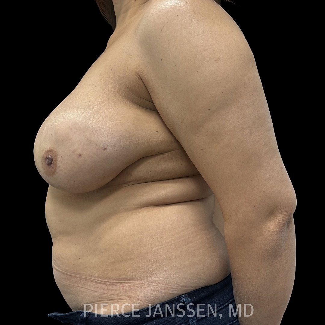 Breast Reconstruction (Implant-Based) Before & After