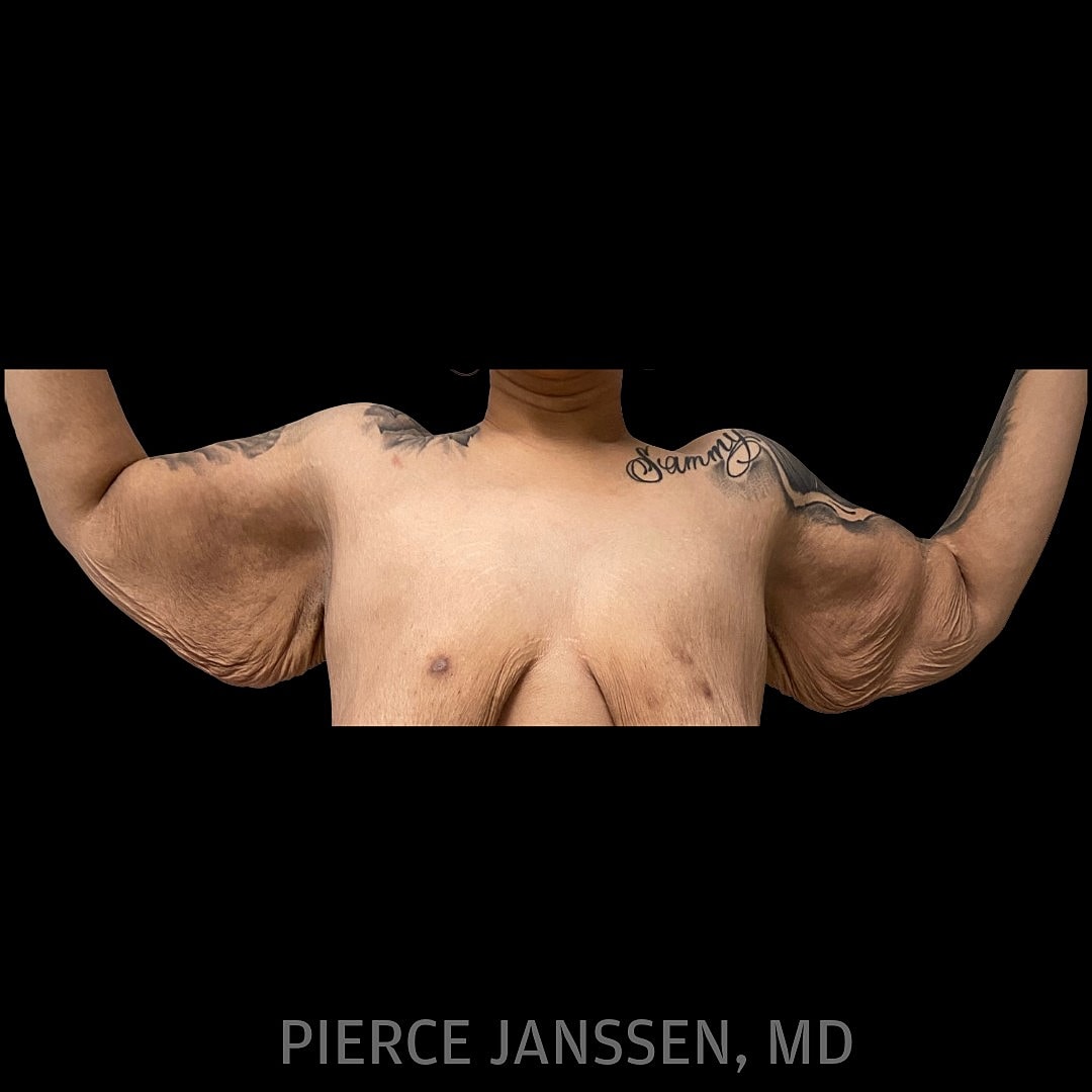Brachioplasty Before & After