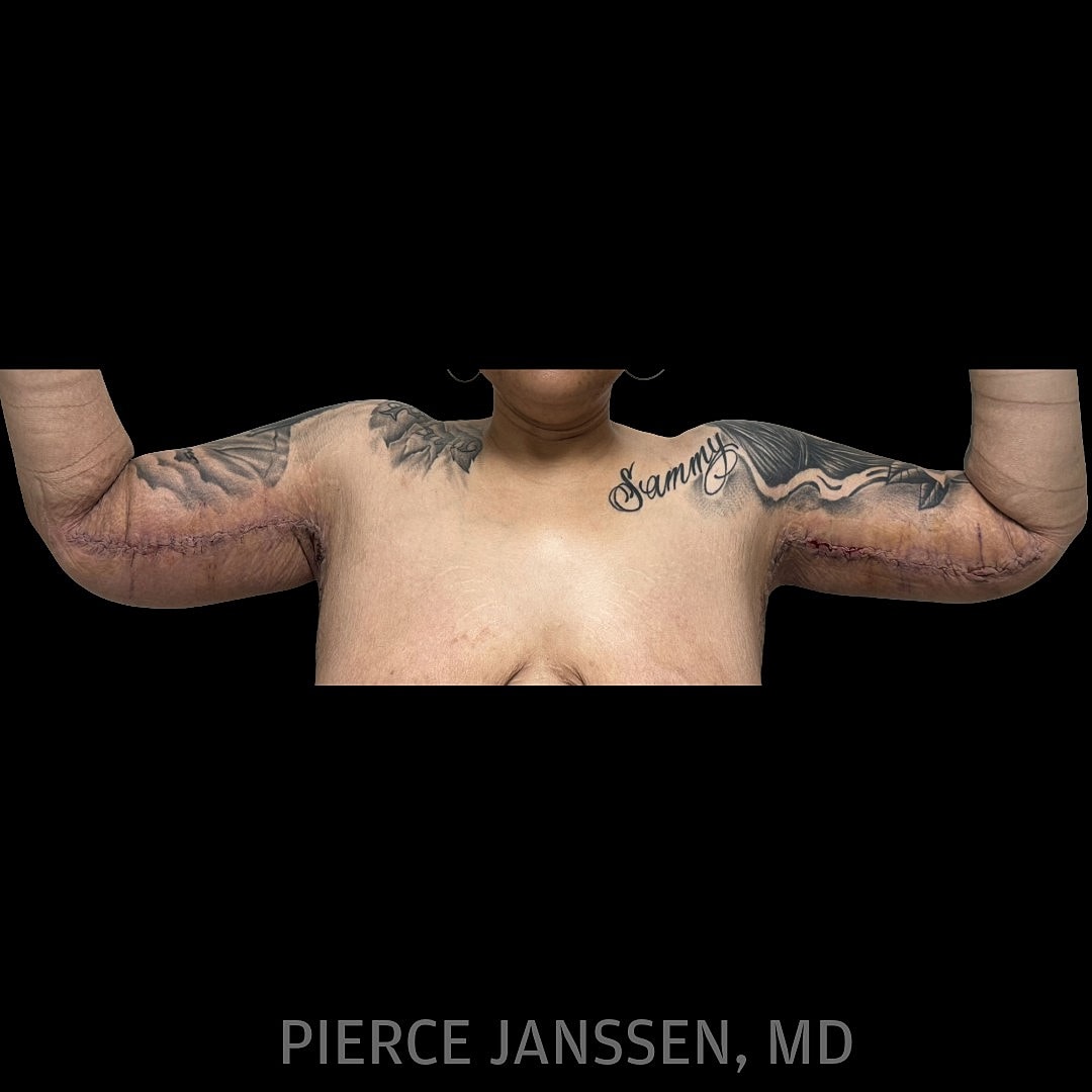 Brachioplasty Before & After